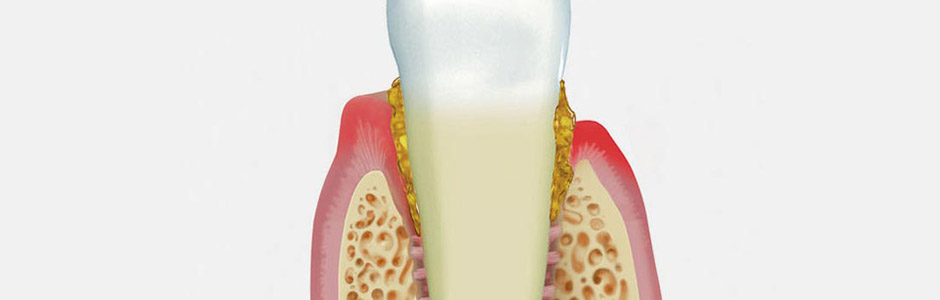 Ursache für eine Parodontitis sind Bakterien, die sich zwischen Zahn und Zahnfleisch ansammeln.